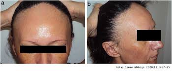 Frontal Fibrosing Alopecia: A Retrospective Study of 75 Patients | Actas Dermo-Sifiliográficas